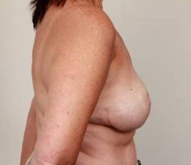 Breast Reconstruction Before & After Gallery - Patient 265055 - Image 4 - Scott Chapin, MD