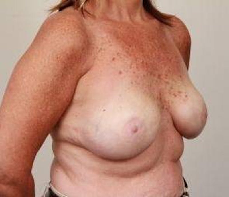 Breast Reconstruction Before & After Gallery - Patient 265055 - Image 6 - Scott Chapin, MD
