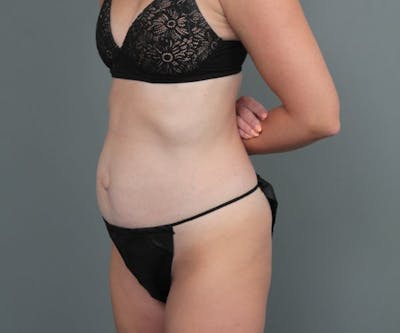 Tummy Tuck Before & After Gallery - Patient 503918 - Image 1 - Scott Chapin, MD