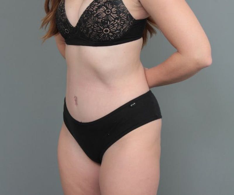Tummy Tuck Before & After Gallery - Patient 503918 - Image 2 - Scott Chapin, MD
