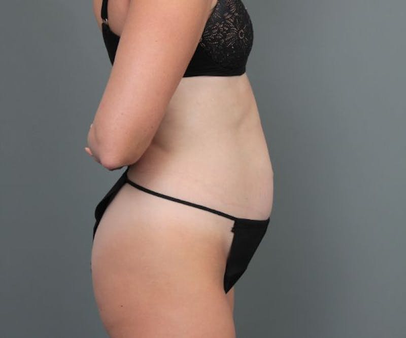 Tummy Tuck Before & After Gallery - Patient 503918 - Image 3 - Scott Chapin, MD