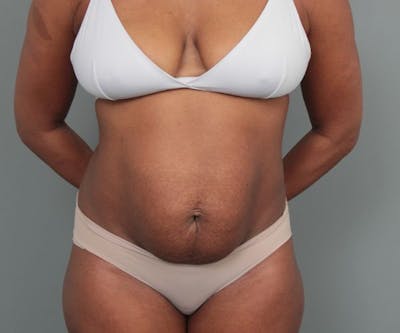 Tummy Tuck Before & After Gallery - Patient 325904 - Image 1 - Scott Chapin, MD