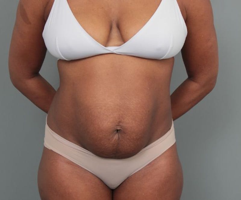Tummy Tuck Before & After Gallery - Patient 325904 - Image 1 - Scott Chapin, MD