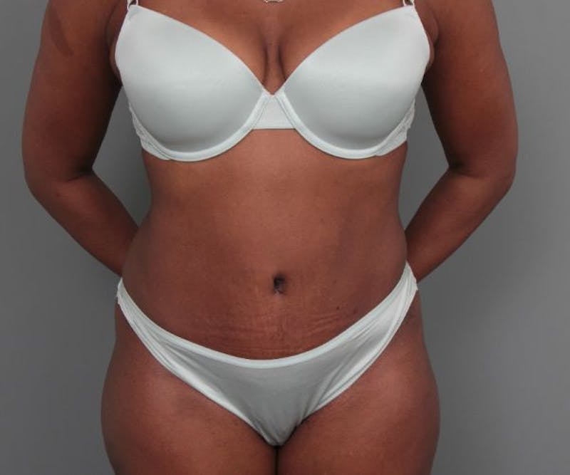Tummy Tuck Before & After Gallery - Patient 325904 - Image 2 - Scott Chapin, MD