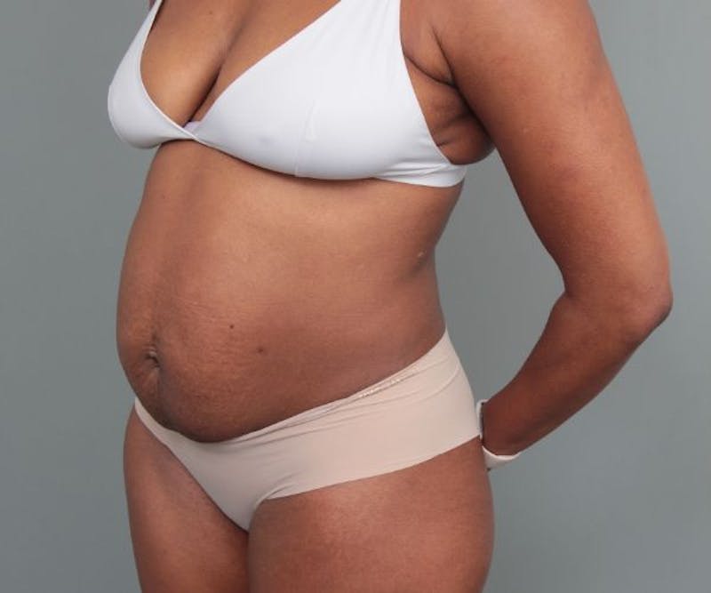 Tummy Tuck Before & After Gallery - Patient 325904 - Image 3 - Scott Chapin, MD