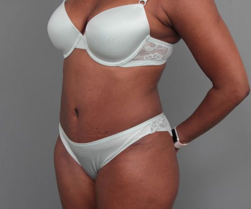 Tummy Tuck Before & After Gallery - Patient 325904 - Image 4 - Scott Chapin, MD