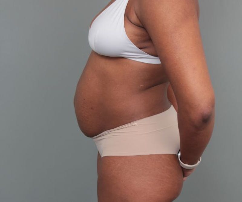 Tummy Tuck Before & After Gallery - Patient 325904 - Image 5 - Scott Chapin, MD