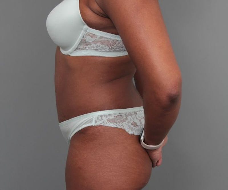 Tummy Tuck Before & After Gallery - Patient 325904 - Image 6 - Scott Chapin, MD