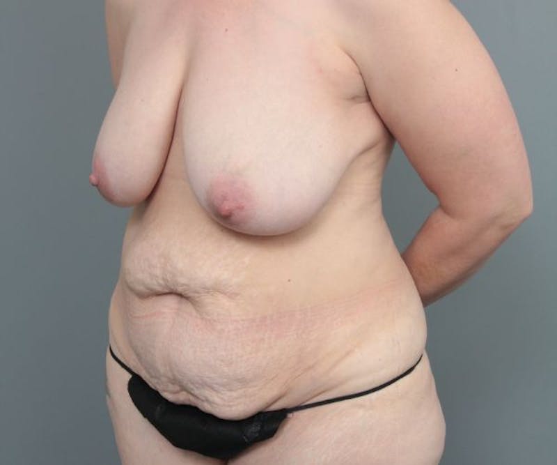 Tummy Tuck Before & After Gallery - Patient 290883 - Image 3 - Scott Chapin, MD