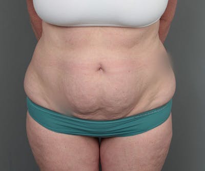 Tummy Tuck Before & After Gallery - Patient 216518 - Image 1 - Scott Chapin, MD