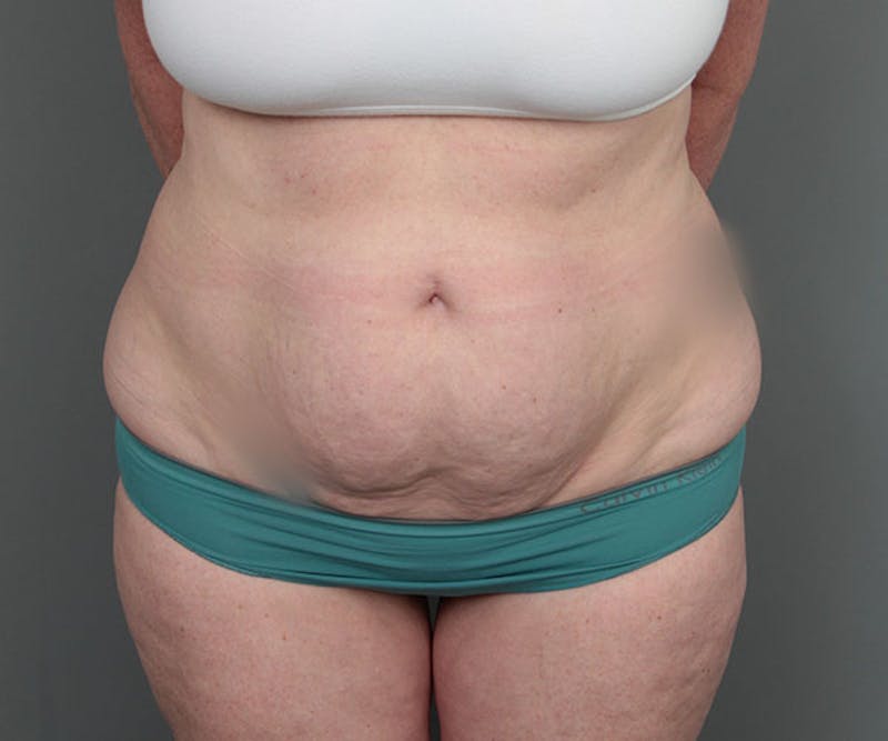 Tummy Tuck Before & After Gallery - Patient 216518 - Image 1 - Scott Chapin, MD
