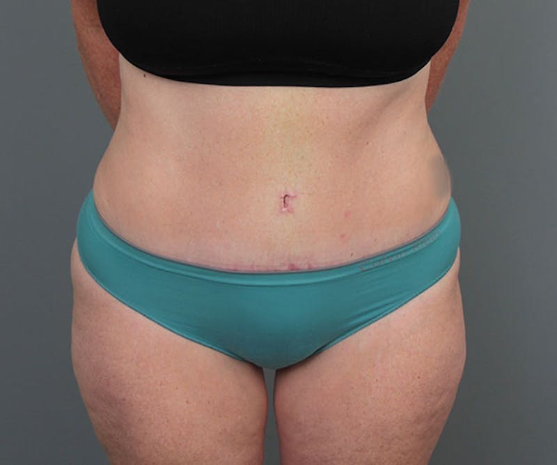 Tummy Tuck Before & After Gallery - Patient 216518 - Image 2 - Scott Chapin, MD