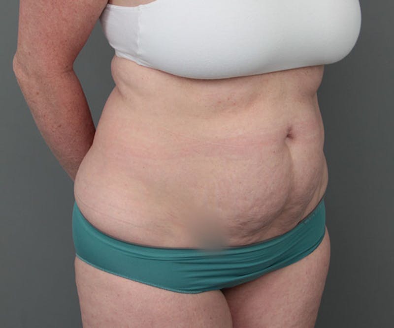 Tummy Tuck Before & After Gallery - Patient 216518 - Image 3 - Scott Chapin, MD