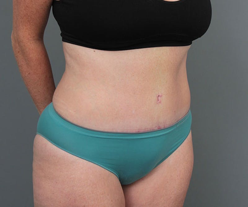 Tummy Tuck Before & After Gallery - Patient 216518 - Image 4 - Scott Chapin, MD