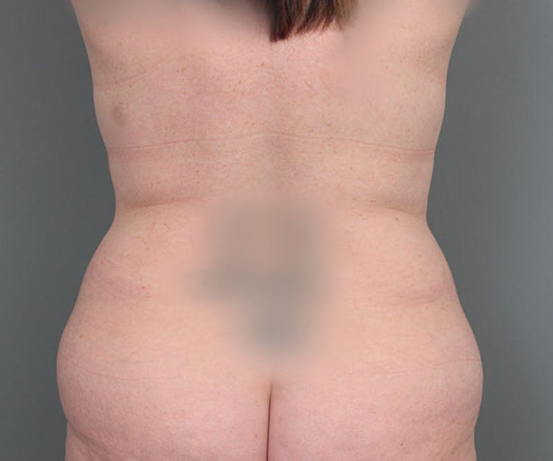 Tummy Tuck Before & After Gallery - Patient 216518 - Image 5 - Scott Chapin, MD