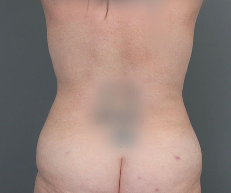 Tummy Tuck Before & After Gallery - Patient 216518 - Image 6 - Scott Chapin, MD