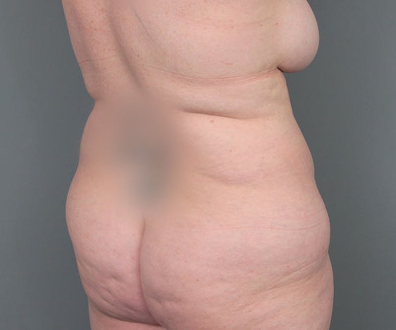 Tummy Tuck Before & After Gallery - Patient 216518 - Image 7 - Scott Chapin, MD