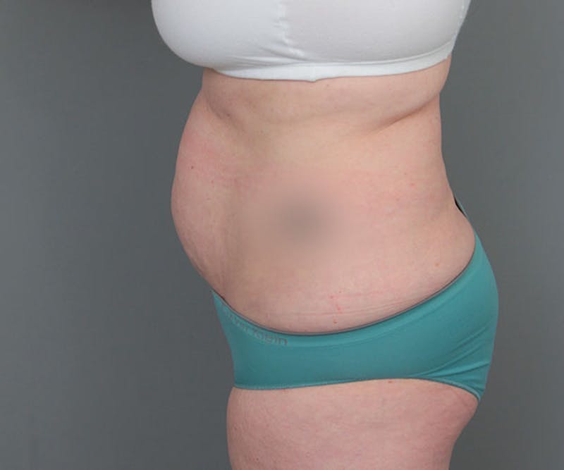 Tummy Tuck Before & After Gallery - Patient 216518 - Image 9 - Scott Chapin, MD