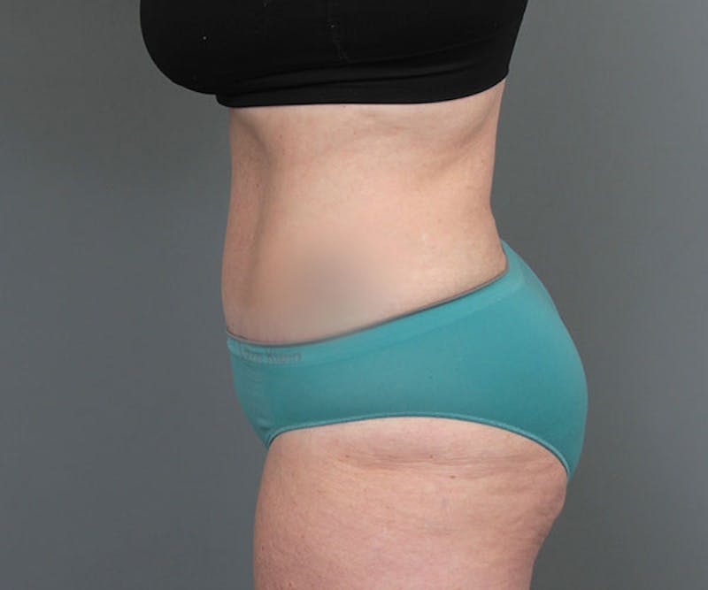 Tummy Tuck Before & After Gallery - Patient 216518 - Image 10 - Scott Chapin, MD