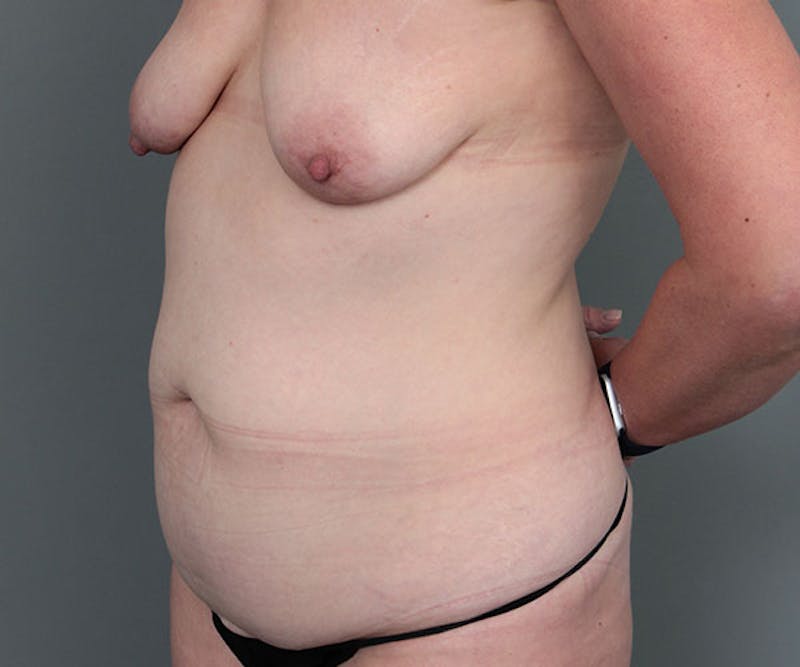 Tummy Tuck Before & After Gallery - Patient 272219 - Image 3 - Scott Chapin, MD
