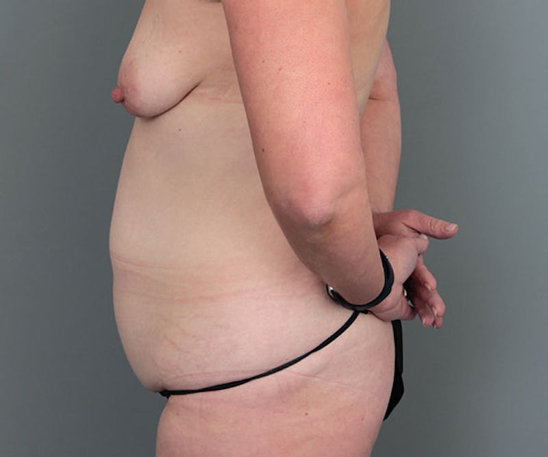 Tummy Tuck Before & After Gallery - Patient 272219 - Image 5 - Scott Chapin, MD