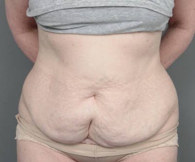 Tummy Tuck Before & After Gallery - Patient 262303 - Image 1 - Scott Chapin, MD