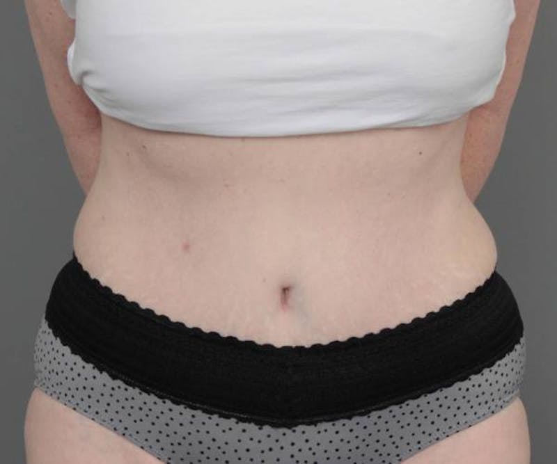 Tummy Tuck Before & After Gallery - Patient 262303 - Image 2 - Scott Chapin, MD