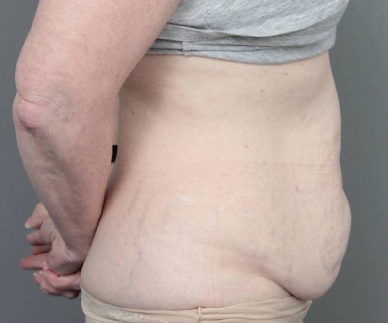 Tummy Tuck Before & After Gallery - Patient 262303 - Image 3 - Scott Chapin, MD