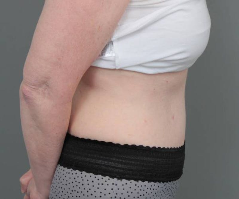 Tummy Tuck Before & After Gallery - Patient 262303 - Image 4 - Scott Chapin, MD