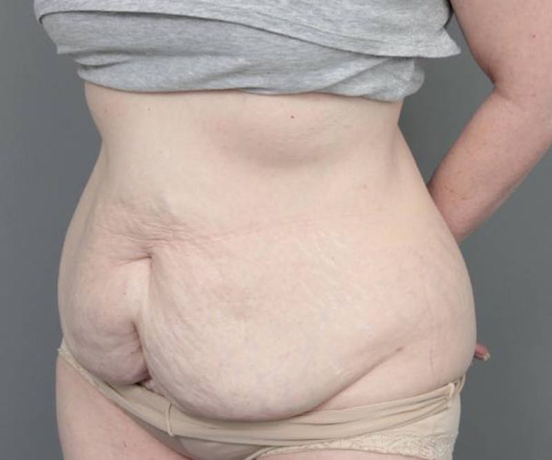 Tummy Tuck Before & After Gallery - Patient 262303 - Image 5 - Scott Chapin, MD