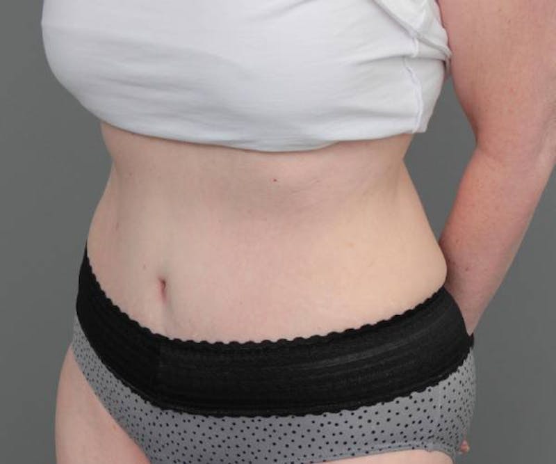 Tummy Tuck Before & After Gallery - Patient 262303 - Image 6 - Scott Chapin, MD