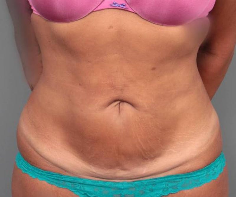 Tummy Tuck Before & After Gallery - Patient 123869 - Image 1 - Scott Chapin, MD