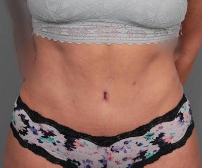 Tummy Tuck Before & After Gallery - Patient 123869 - Image 2 - Scott Chapin, MD