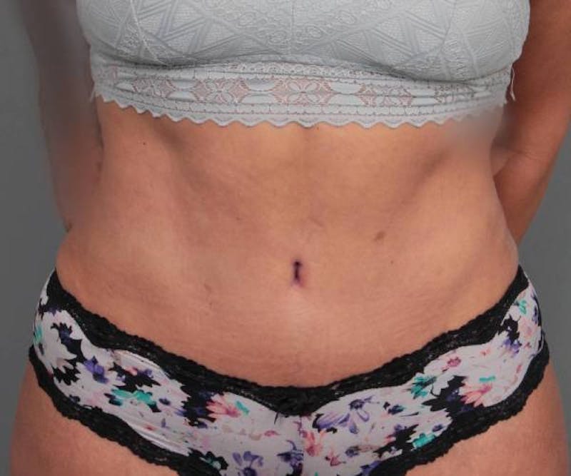 Tummy Tuck Before & After Gallery - Patient 123869 - Image 2 - Scott Chapin, MD