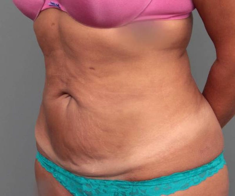 Tummy Tuck Before & After Gallery - Patient 123869 - Image 5 - Scott Chapin, MD