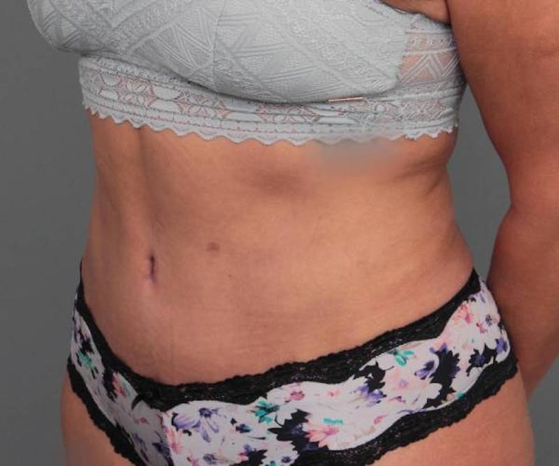 Tummy Tuck Before & After Gallery - Patient 123869 - Image 6 - Scott Chapin, MD
