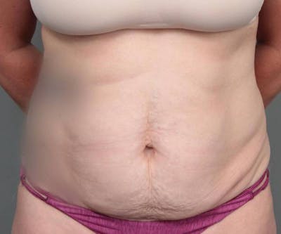 Tummy Tuck Before & After Gallery - Patient 969597 - Image 1 - Scott Chapin, MD