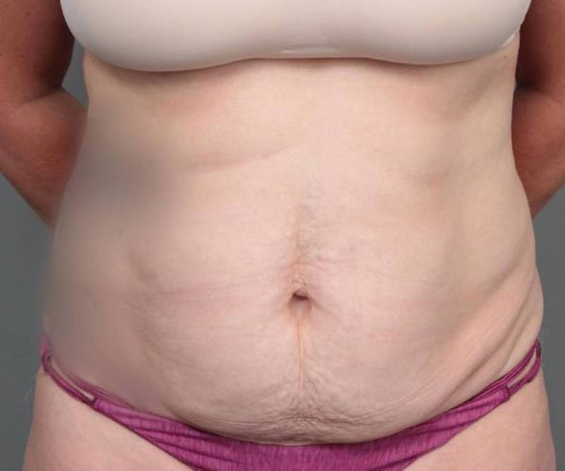 Tummy Tuck Before & After Gallery - Patient 969597 - Image 1 - Scott Chapin, MD