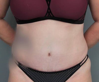 Tummy Tuck Before & After Gallery - Patient 969597 - Image 2 - Scott Chapin, MD