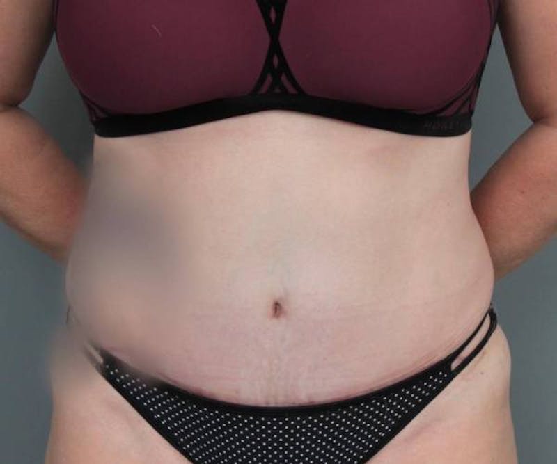 Tummy Tuck Before & After Gallery - Patient 969597 - Image 2 - Scott Chapin, MD