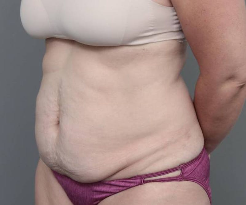 Tummy Tuck Before & After Gallery - Patient 969597 - Image 3 - Scott Chapin, MD