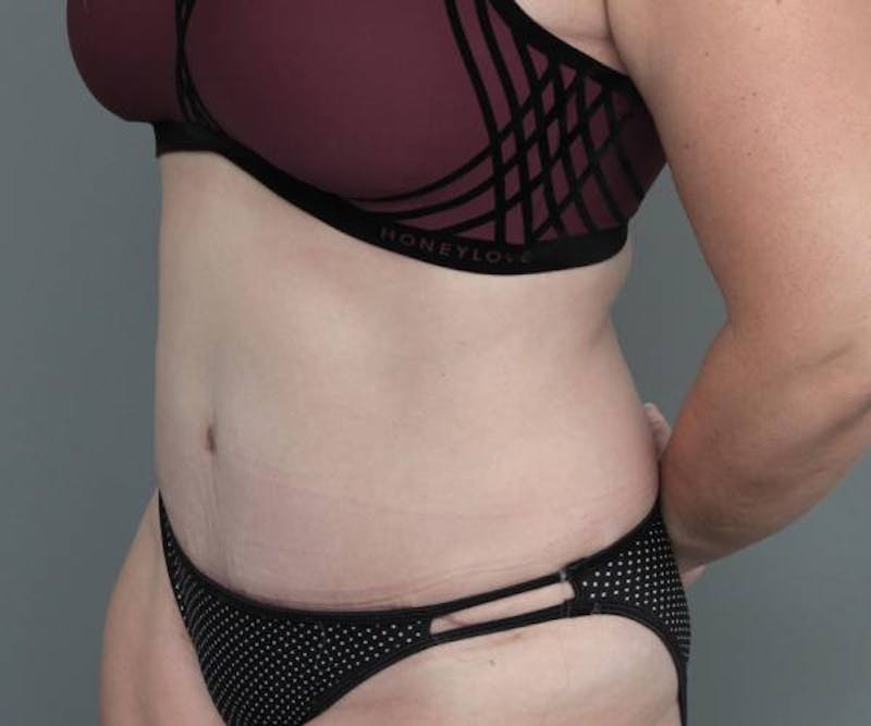 Tummy Tuck Before & After Gallery - Patient 969597 - Image 4 - Scott Chapin, MD