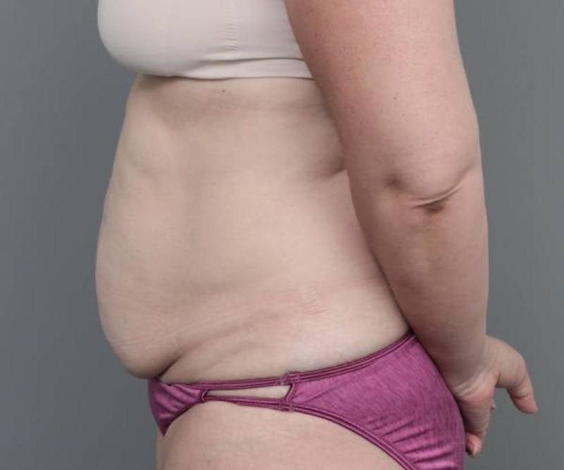 Tummy Tuck Before & After Gallery - Patient 969597 - Image 5 - Scott Chapin, MD