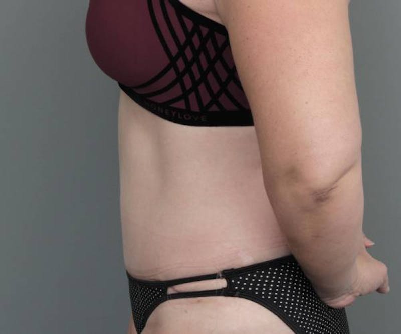 Tummy Tuck Before & After Gallery - Patient 969597 - Image 6 - Scott Chapin, MD
