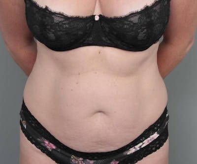 Tummy Tuck Before & After Gallery - Patient 203079 - Image 1 - Scott Chapin, MD
