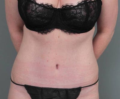 Tummy Tuck Before & After Gallery - Patient 203079 - Image 2 - Scott Chapin, MD