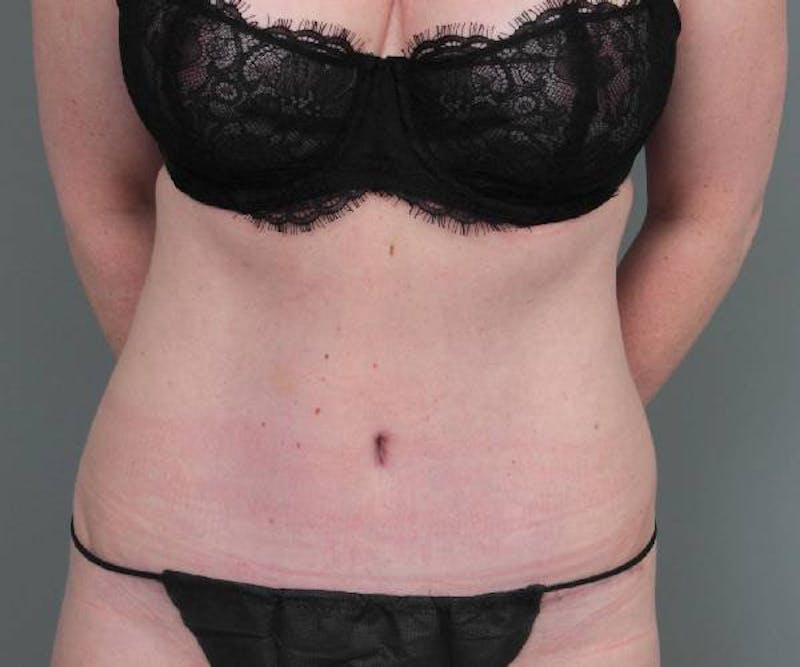 Tummy Tuck Before & After Gallery - Patient 203079 - Image 2 - Scott Chapin, MD