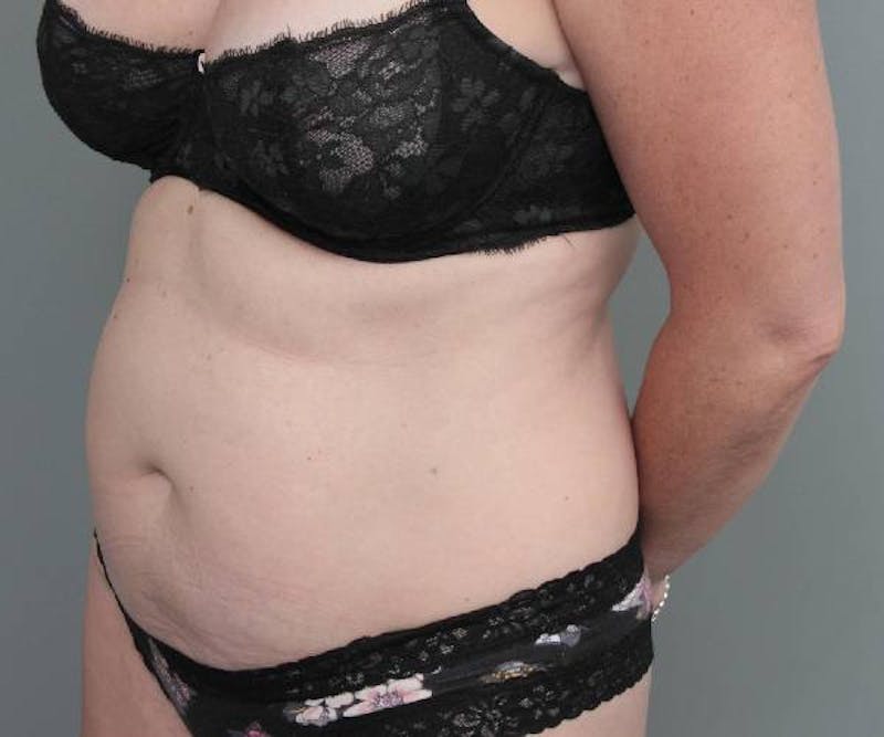 Tummy Tuck Before & After Gallery - Patient 203079 - Image 5 - Scott Chapin, MD