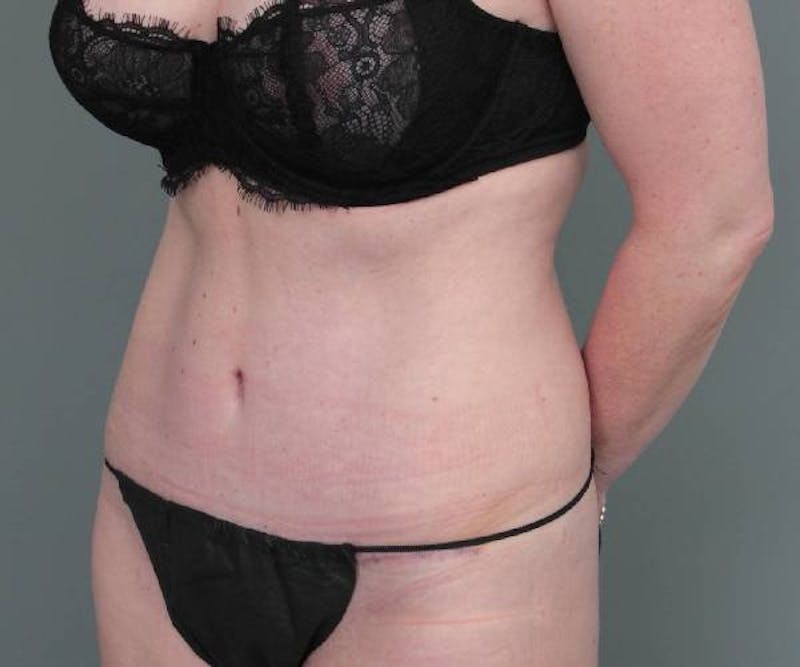 Tummy Tuck Before & After Gallery - Patient 203079 - Image 6 - Scott Chapin, MD