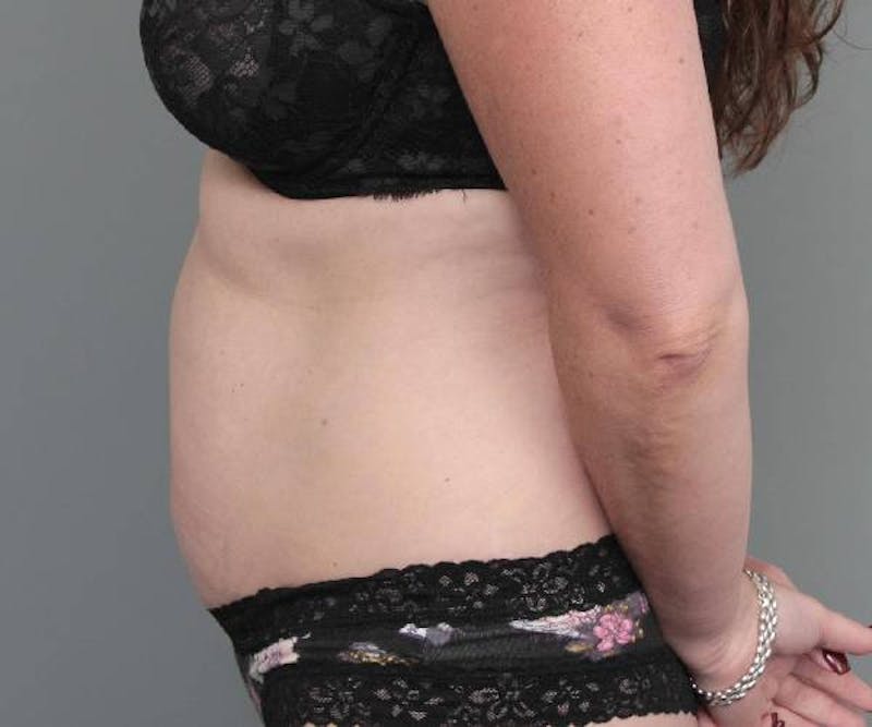 Tummy Tuck Before & After Gallery - Patient 203079 - Image 7 - Scott Chapin, MD